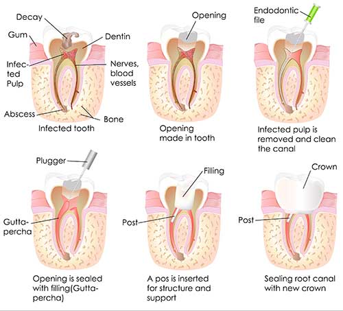 Root Canal Therapy in Kihei