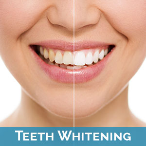 Teeth Whitening Wailuku