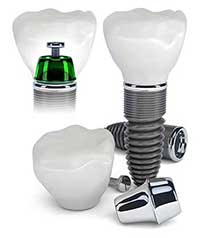 Dental Implants in Kihei