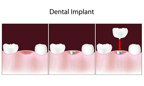 Implant Dentist in Kihei