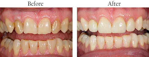 Kahului Before and After Dental Crowns