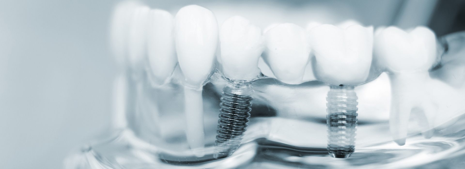 The image shows a close-up view of a dental implant with screws and other components, likely used for oral care or dental procedures.